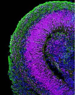 Usa; Nuova terapia staminale dà speranza a gente paralizzata