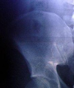 Ricerca/ Cnr: l’osso torna nuovo con una iniezione
