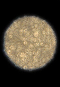 Scienza/ Test urine può rivelare propensione tumore prostata