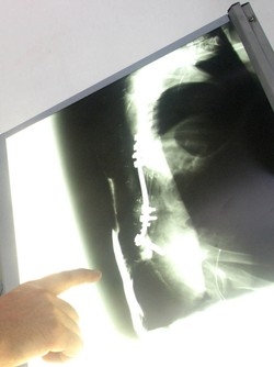 Studiano il mal di schiena utilizzando vecchi scheletri