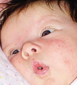 In classe esplode la varicella
«Genitori, vaccinate i bimbi»