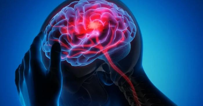 L’ospedale di Saronno protagonista della ricerca internazionale sull’ictus: pubblicato uno studio che può cambiare la diagnosi